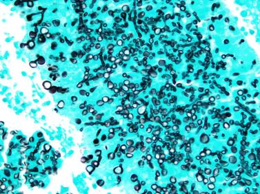 Immune modulation can effectively combat Valley Fever